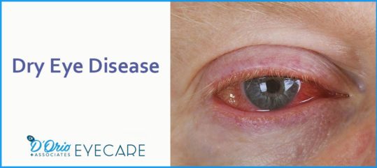 DRY EYE DISEASE - Best Optometrist in Toronto