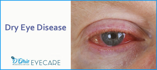 DRY EYE DISEASE - Optometrist in