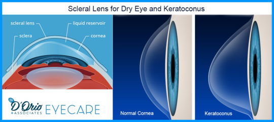 The Advantages Of The Scleral Lens For Dry Eye And Keratoconus