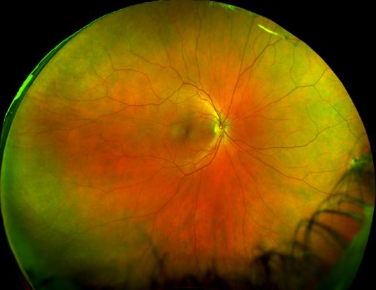 What Optomap Retinal Imaging Can Do For Your Eye Health