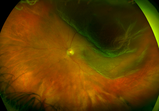 Scans 0001 Retinal Detachment