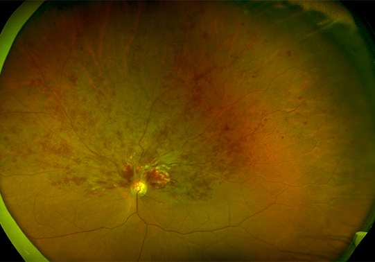 Scans 0004 Retinal Vein Occlusion