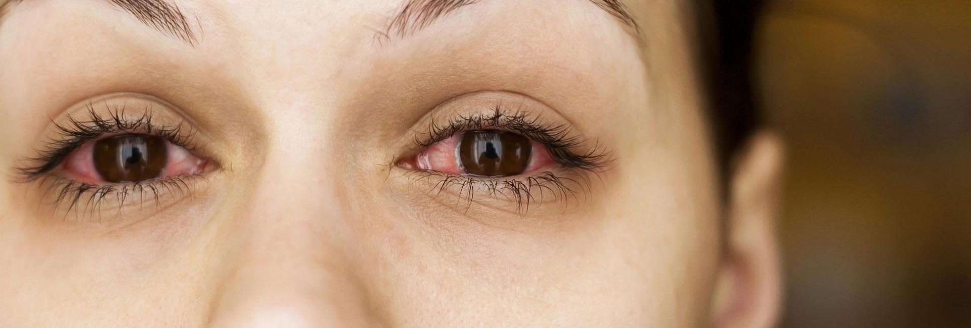 Symptoms 0010 Dry Eyes