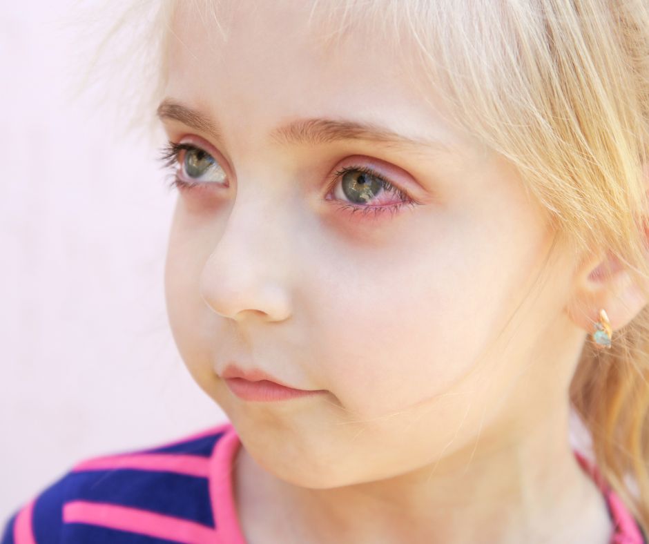 Top 3 Facts About Conjunctivitis