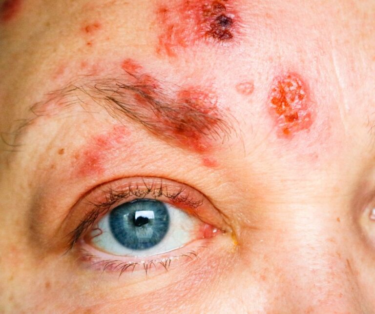 Shingles In The Eyes: Symptoms, Diagnosis, And Complications - D'Orio