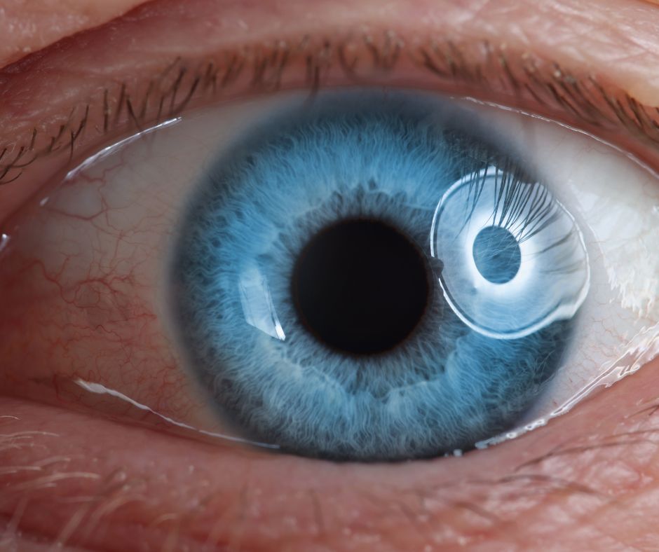 Posterior Vitreous Detachment - Understanding Symptoms, Causes, and ...